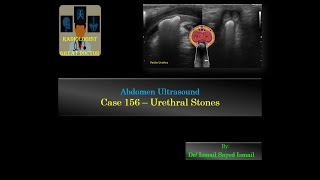 Ultrasound Case 156  Anterior Urethral Stone [upl. by Acinelav]