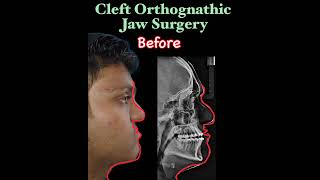 Patient Testimonial World Best Cleft and Orthognathic Jaw Surgery at GSR Hospital Hyderabad India [upl. by Eillat]