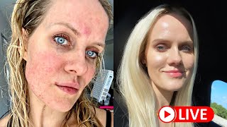 How I cured my ROSACEA naturally [upl. by Jovitah895]