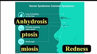 Horner Syndrome [upl. by Ace]