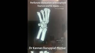 Perilunate dislocation with scaphoid fracture and SL injury fixed with Herbert screws and multiple K [upl. by Huttan]