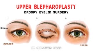 Droopy Upper Eyelid Surgery  Blepharoplasty 👁️ [upl. by Oxford]