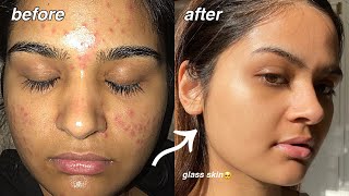 how i cleared my acne FOR GOOD something finally worked [upl. by Rodi]