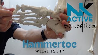 What is hammertoe [upl. by Eyks747]