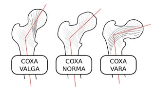 ANGLE OF INCLINATION  COXA VALGA AND COXA VERA 👍 [upl. by Gnahc]