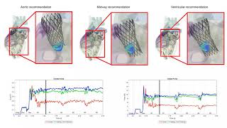 LHHM CoreValve [upl. by Noyar91]