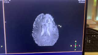 MRI brain perfusion exam on Philips Ingenia How to set it up and how to post process￼ ￼ [upl. by Imarej]