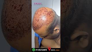 6000 Graft Hair Transplant Grade 7 Baldness  Dr Suneet hairtransplantresults costofhairtransplant [upl. by Kearney867]