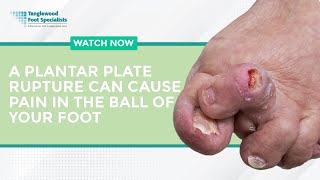 A Plantar Plate Rupture Can Cause Pain in the Ball of Your Foot [upl. by Yelrah779]