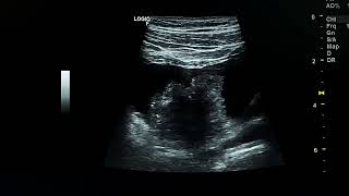 Ultrasound case of urinary bladder tumor in 50 yrs old male [upl. by Erasmus]