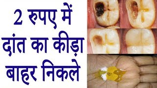 सिर्फ एक बार इस्तेमाल से दांत का कीड़ा बाहर निकालें  How To Get Rid Of Tooth Cavity 100 Effective [upl. by Gallenz]