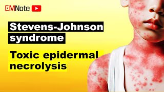 Stevens Johnson Syndrome SJS and TEN [upl. by Adalia325]