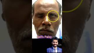 Bells palsy shorts [upl. by Assecnirp]