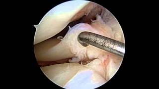 Lateral Meniscus Repair [upl. by Eirrem]