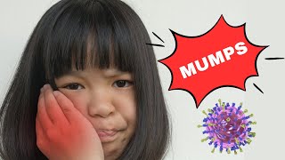 Mumps  Causes Signs amp Symptoms Diagnosis And Treatment [upl. by Osric]