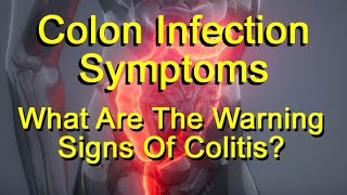 Colon Infection Symptoms  What Are The Warning Signs Of Colitis [upl. by Silohcin]