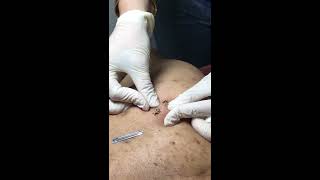 Squeeze amp Pop Cyst 1 [upl. by Siegel891]