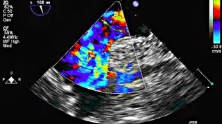 Interatrial Septal Aneurysm and Patent Foramen Ovale  Echocardiography [upl. by Browning157]