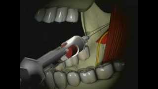 Mandibular Anesthesia  Inferior Alveolar Nerve Block [upl. by Erin]