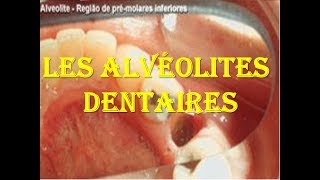 Les alvéolites dentaires [upl. by Pia]