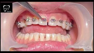 DIASTEMA CLOSURE  BRACES  Orthodontics dentalbraces dentalclinic dental trending anantnag 🙂🙂🙂 [upl. by Maon]