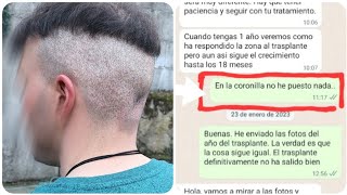 EL ABUSO en los INJERTOS CAPILARES revelado por un paciente valiente [upl. by Naihr169]