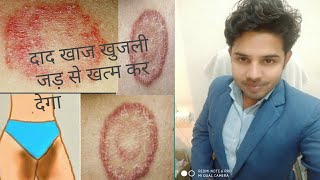 SALICYLIC ACID IP फ़ंगस इनफ़ेक्शन दिनाय दाद खाज का इलाज  Treating Fungal Infection In HINDI [upl. by Aneleiram]