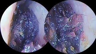 The best removal of wet earwax asmrearwax 14 [upl. by Marylin]