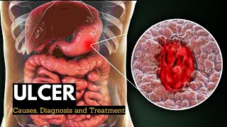 Ulcer Causes Signs and Symptoms Diagnosis and Treatment [upl. by Goat538]