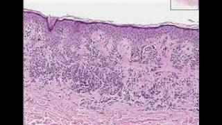 Histopathology SkinCompound Clarks nevus dysplastic nevus [upl. by Snilloc]