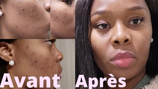 COMMENT se débarrasser des BOUTONS et TACHES sur le visage  ROUTINE Ducray  Samantha MK [upl. by Loni]