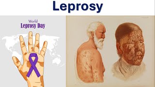 Understanding Leprosy Its Causes Symptoms Treatment amp Prevention  Hansens Disease  M Leprae [upl. by Aiciruam640]