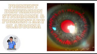 Pigment Dispersion Syndrome and Pigmentary Glaucoma I Eye Dr Explains 2023 [upl. by Gertrud]