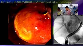 ERCP for advanced GB neoplasia [upl. by Akienahs590]