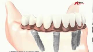 Fix Loose and Uncomfortable Dentures [upl. by Maressa]