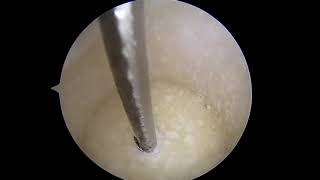 Subchondral Solutions  Clinical Video for PFJ [upl. by Ynaittirb]