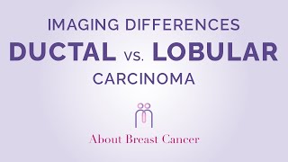 Imaging Differences between Ductal and Lobular Carcinoma [upl. by Li]