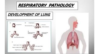 Respo pathology  Development of lungs syndrome congenital pathology [upl. by Otte355]