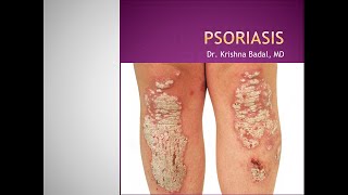 Psoriasis [upl. by Airdnekal348]