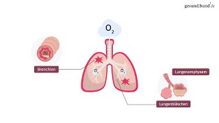 Was ist eine chronisch obstruktive Lungenerkrankung COPD [upl. by Vallonia]