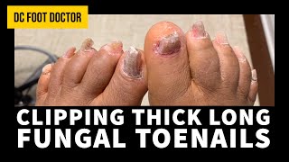 Clipping Thick Long Fungal Toenails [upl. by Aicenert]