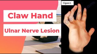 Claw Hand  Ulnar Nerve Lesion  PhysiotherapyKnowledge [upl. by Vastah169]