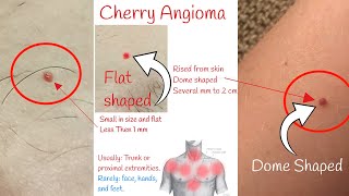 Cherry angioma  Red moles on skin [upl. by Nylrahs794]