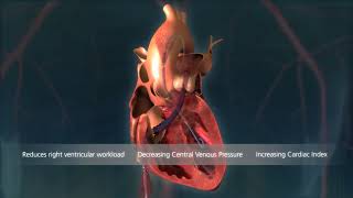 Impella RP® Heart Pump [upl. by Poyssick]