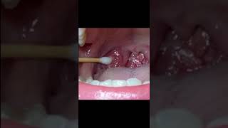 Tonsil stone extraction [upl. by Elita953]