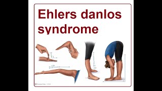 Ehlers Danlos Syndrome  2024 [upl. by Secnarfyram]