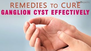 10 Remedies to Cure Ganglion Cyst Effectively [upl. by Eceinert202]