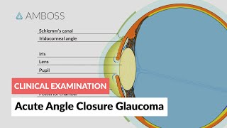 Acute Angle Closure Glaucoma [upl. by Dubenko]