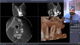 ENDOCAST  RETRATAMENTO ENDODÃ”NTICO DENTE 26 SOB A Ã“TICA DA ENDODONTIA CONTEMPORÃ‚NEA [upl. by Trescott280]