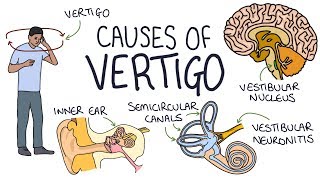 Understanding the Causes of Vertigo [upl. by Ahsoyem723]